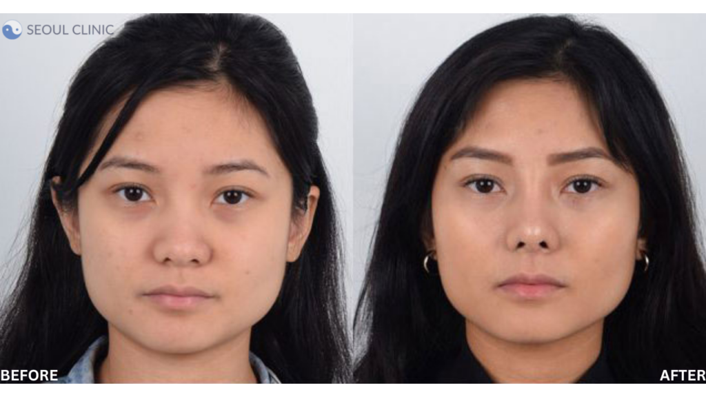 Before And After An Asian Nose Rhinoplasty Surgery
