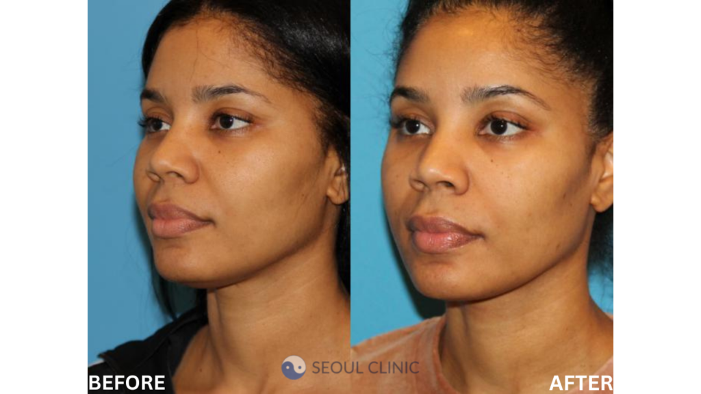 An Image Of A Woman After Having A Neck Lift Procedure Done