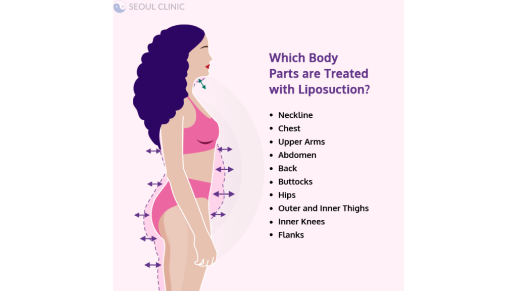 Liposuction Korea: Cost, Clinic, What To Expect, March 2024