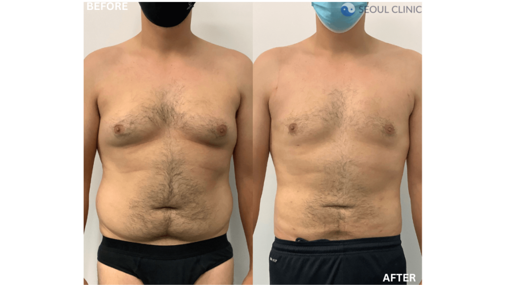 Liposuction Before And After 1