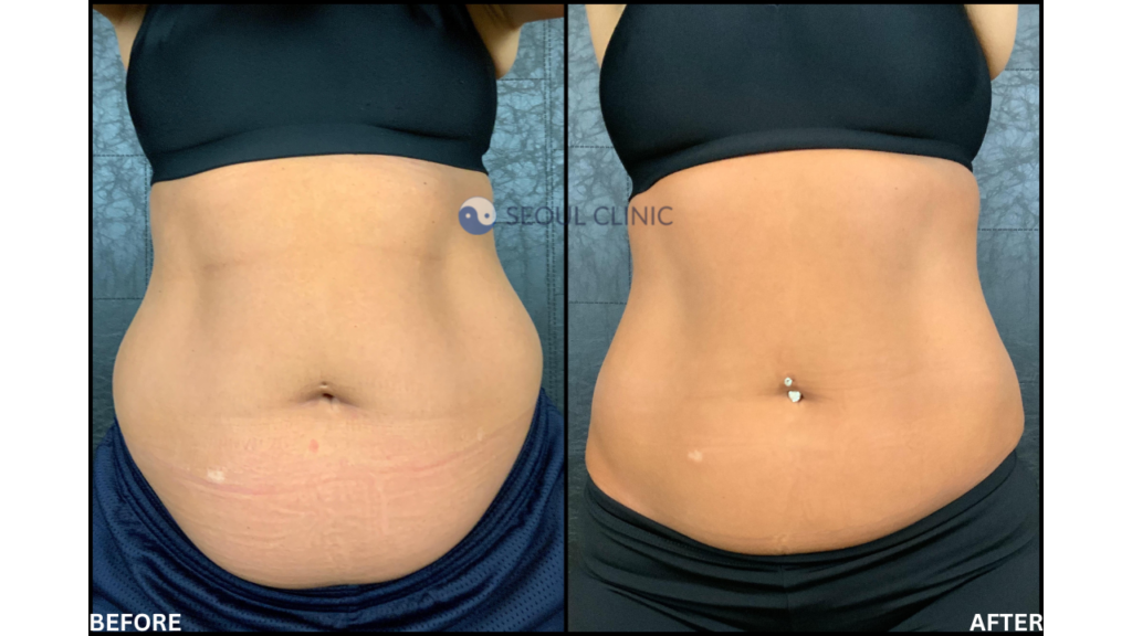 Before And After CoolSculpting