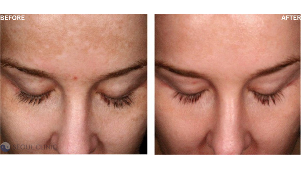 Before And After Pictures Of Skin Whitening Laser Treatment