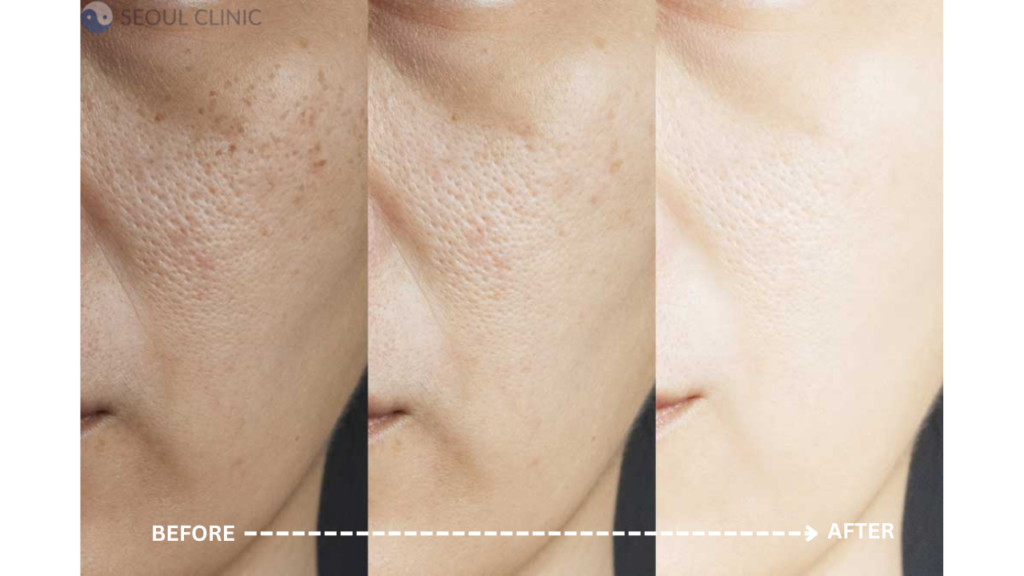 Before And After Pictures Of Skin Whitening Glutathione Injections Treatment