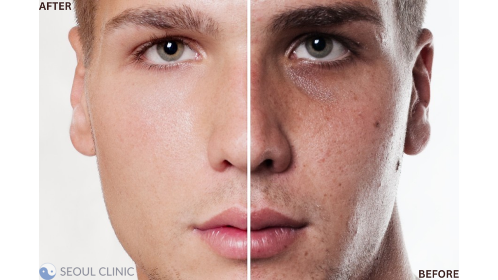 Before And After Skin Whitening