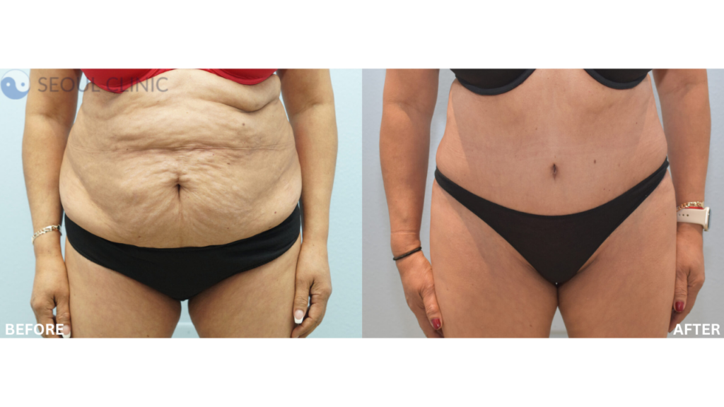 Before And After Tummy Tuck 2