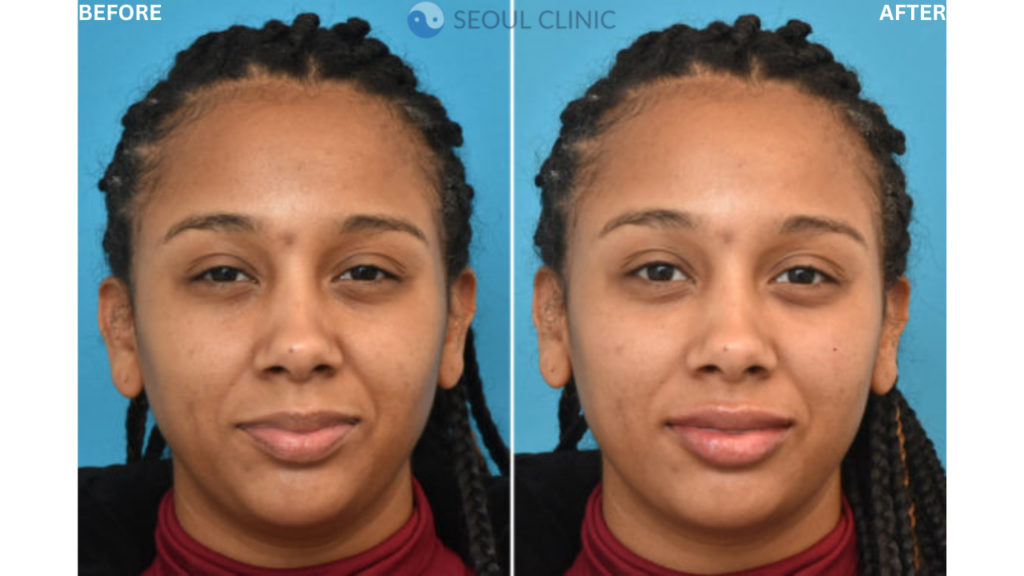 Dermal Fillers Before And After 1