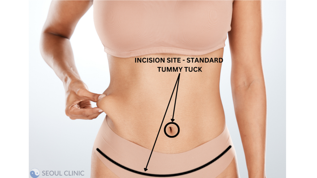 Incision Site For A Standard Or Full Abdominoplasty