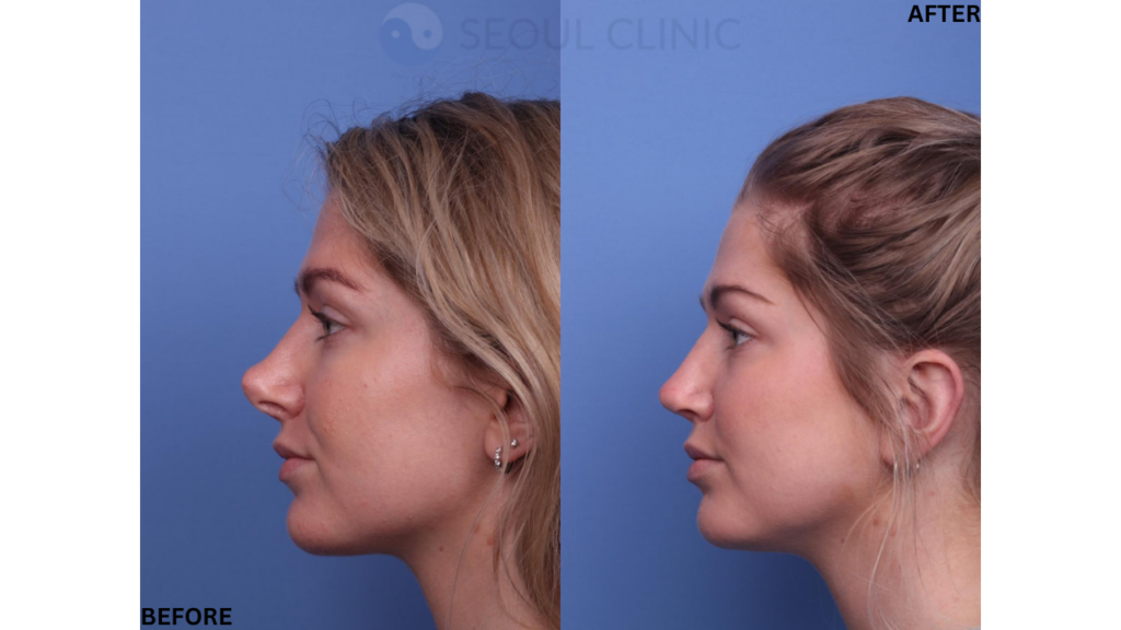 Before And After A Revision Rhinoplasty