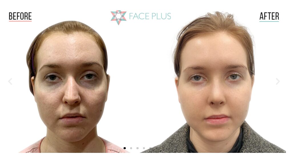 Before And After A Revision Rhinoplasty In Korea At FacePlus Plastic Surgery